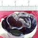 Infectious Retinitis